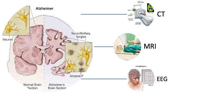 Diagnostic Methods for Alzheimer disease